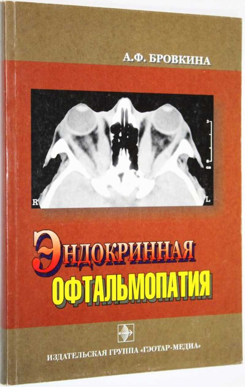 Эндокринная офтальмопатия